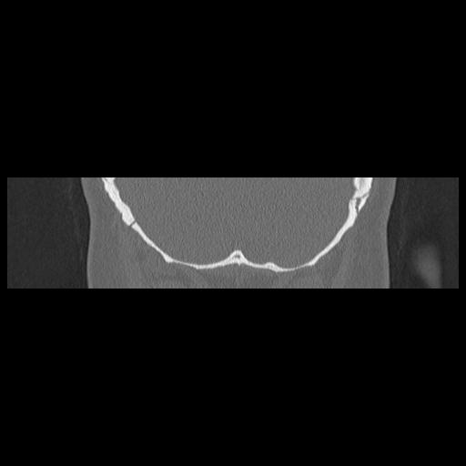 Cholesteatoma (Radiopaedia 84946-100455 Coronal bone window 138).jpg