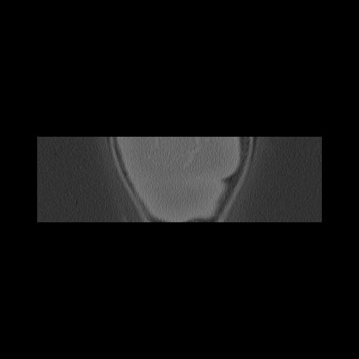 Cholesteatoma (Radiopaedia 84946-100455 Coronal bone window 178).jpg