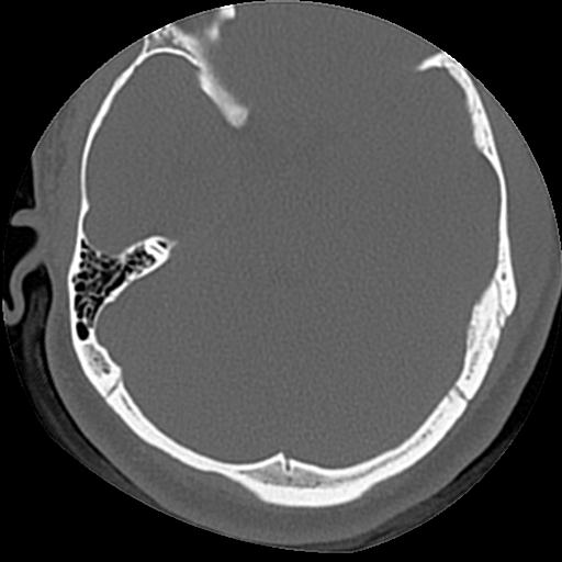 Cholesteatoma (Radiopaedia 84960-100474 Axial bone window 27).jpg