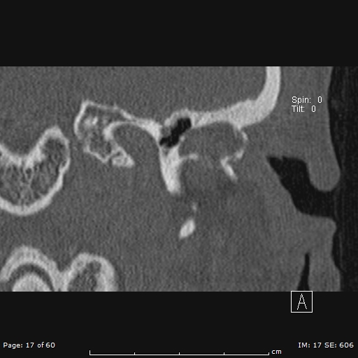 File:Cholesteatoma - external auditory canal (Radiopaedia 88452-105096 Coronal bone window 17).jpg