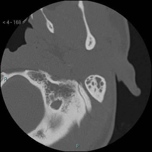 Cholesterol granuloma of the petrous apex (Radiopaedia 64358-73141 Axial bone window 81).jpg