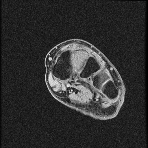File:Chondroblastoma - midfoot (Radiopaedia 64831-73765 F 16).jpg
