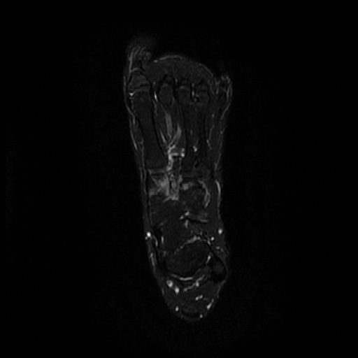 File:Chondroblastoma - midfoot (Radiopaedia 64831-73765 Long axis T2 fat sat 13).jpg