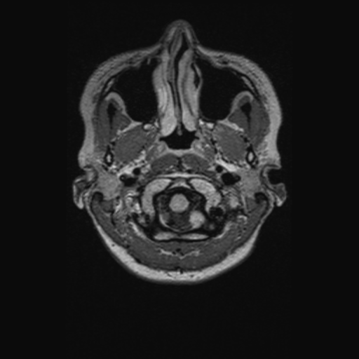 Chondrosarcoma (Radiopaedia 41937-44939 Axial FLAIR 11).png