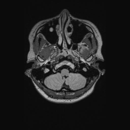 Chondrosarcoma (Radiopaedia 41937-44939 Axial FLAIR 18).png