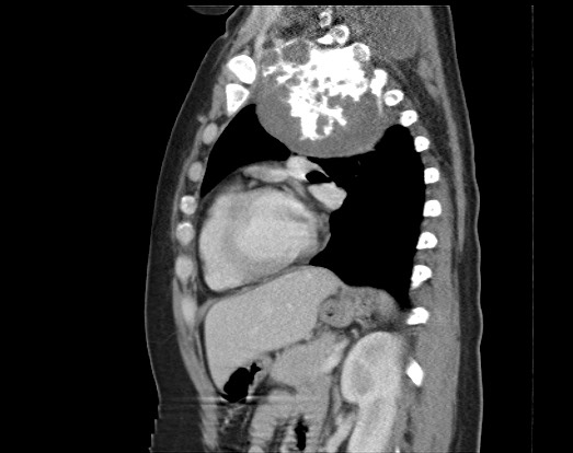 Chondrosarcoma - chest wall (Radiopaedia 65192-74199 B 25).jpg