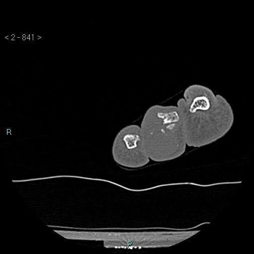 Chondrosarcoma - phalanx (Radiopaedia 69047-78812 Axial bone window 95).jpg