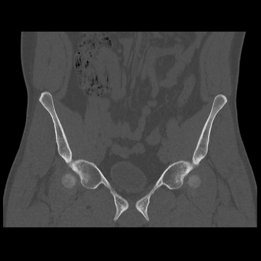 Chondrosarcoma of iliac wing (Radiopaedia 63861-72599 Coronal bone window 43).jpg