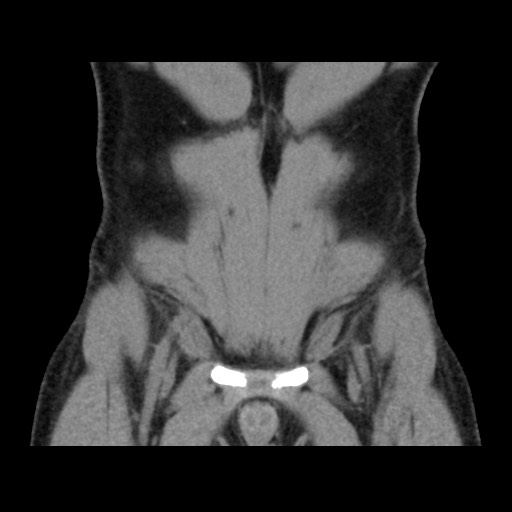 Chondrosarcoma of iliac wing (Radiopaedia 63861-72599 Coronal non-contrast 26).jpg