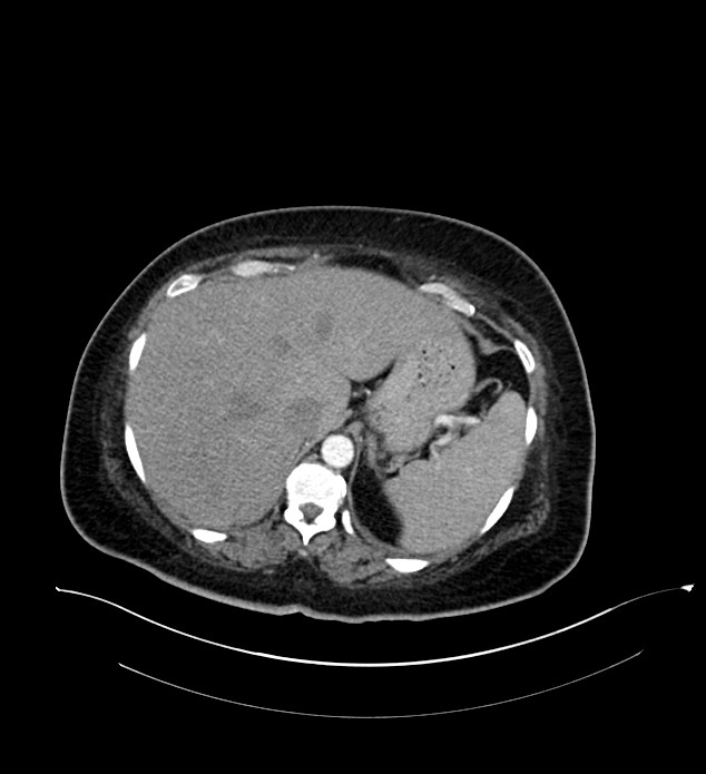 Chromophobe renal cell carcinoma (Radiopaedia 84239-99519 B 16).jpg