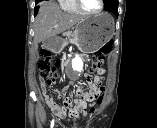 Chronic contained rupture of abdominal aortic aneurysm with extensive erosion of the vertebral bodies (Radiopaedia 55450-61901 D 12).jpg