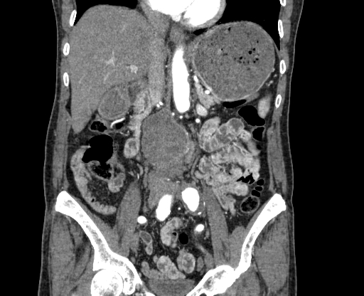 File:Chronic contained rupture of abdominal aortic aneurysm with extensive erosion of the vertebral bodies (Radiopaedia 55450-61901 D 34).jpg