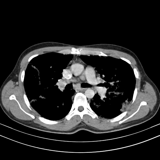 Chronic eosinophilic pneumonia (Radiopaedia 39331-41587 Axial C+ delayed 49).png