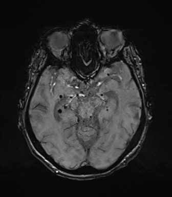 Chronic hypertensive encephalopathy (Radiopaedia 72844-83495 Axial SWI 33).png