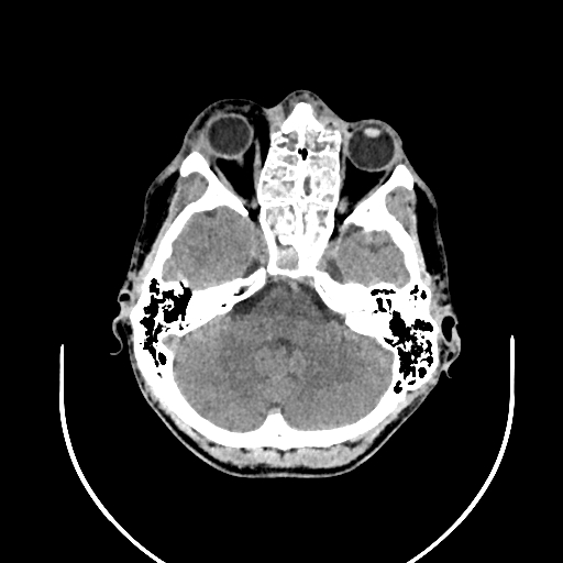 Chronic invasive fungal sinusitis (Radiopaedia 50342-55710 Axial non-contrast 45).jpg