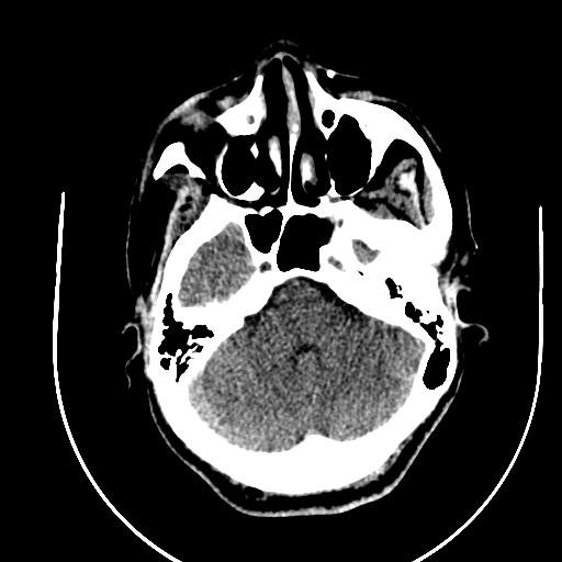 Chronic invasive fungal sinusitis (Radiopaedia 91563-109286 Axial non-contrast 20).jpg