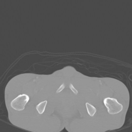 Chronic large bowel pseudo-obstruction (Radiopaedia 43181-46492 Axial bone window 166).jpg