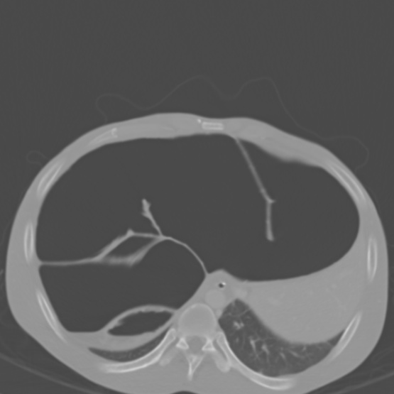 Chronic large bowel pseudo-obstruction (Radiopaedia 43181-46492 Axial bone window 39).jpg