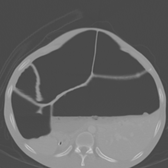 Chronic large bowel pseudo-obstruction (Radiopaedia 43181-46492 Axial bone window 55).jpg