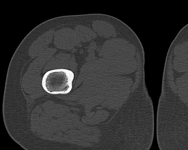 Chronic ostemyelitis of the femur with long sinus tract (Radiopaedia 74947-85982 Axial bone window 33).jpg