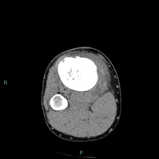 Chronic osteomyelitis (with Brodie abscess) (Radiopaedia 76405-88111 A 72).jpg