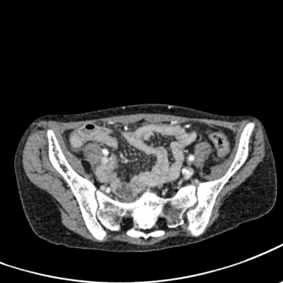Chronic pancreatitis (Radiopaedia 55405-61846 A 82).jpg