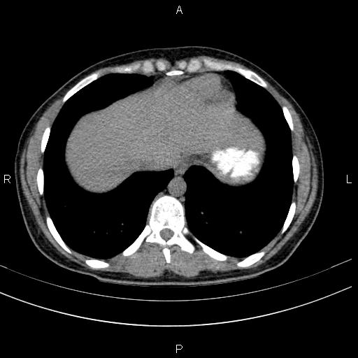 Chronic pancreatitis (Radiopaedia 64576-73450 Axial non-contrast 6).jpg
