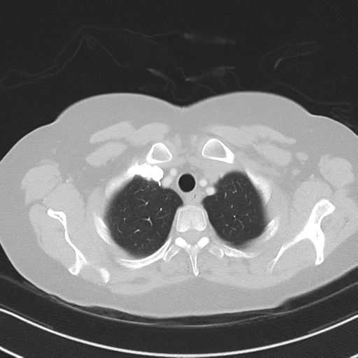 Chronic pulmonary embolus (Radiopaedia 39129-41341 Axial lung window 11).png