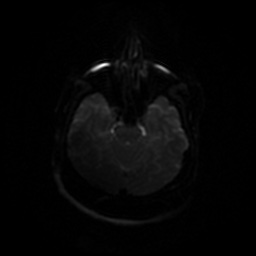 Chronic submandibular sialadenitis (Radiopaedia 61852-69885 Axial DWI 31).jpg