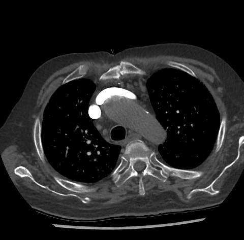 Chronic thromboembolic pulmonary disease (Radiopaedia 90694-108119 Axial C+ CTPA 27).jpg