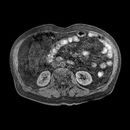 Cirrhosis and hepatocellular carcinoma in the setting of hemochromatosis (Radiopaedia 75394-86594 Axial T1 C+ fat sat 12).jpg