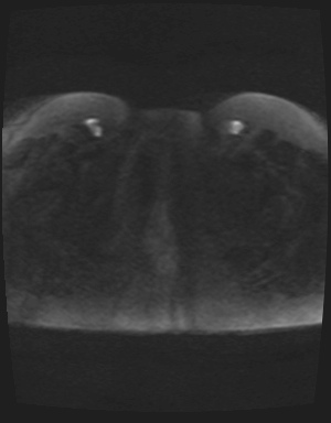 Class II Mullerian duct anomaly- unicornuate uterus with rudimentary horn and non-communicating cavity (Radiopaedia 39441-41755 Axial DWI 94).jpg