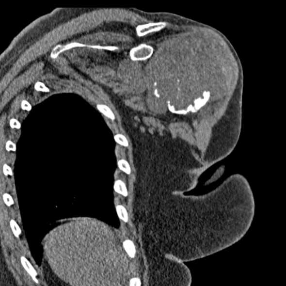 Clear cell chondrosarcoma - humerus (Radiopaedia 63104-71612 Coronal non-contrast 36).jpg