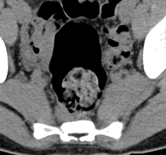 File:Clear cell meningoma - lumbar spine (Radiopaedia 60116-67691 Axial non-contrast 87).png