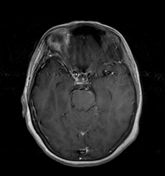 File:Clival meningioma (Radiopaedia 53278-59248 Axial T1 C+ 8).jpg