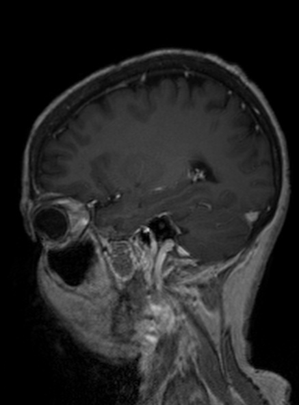 File:Clival meningioma (Radiopaedia 53278-59248 Sagittal T1 C+ 312).jpg