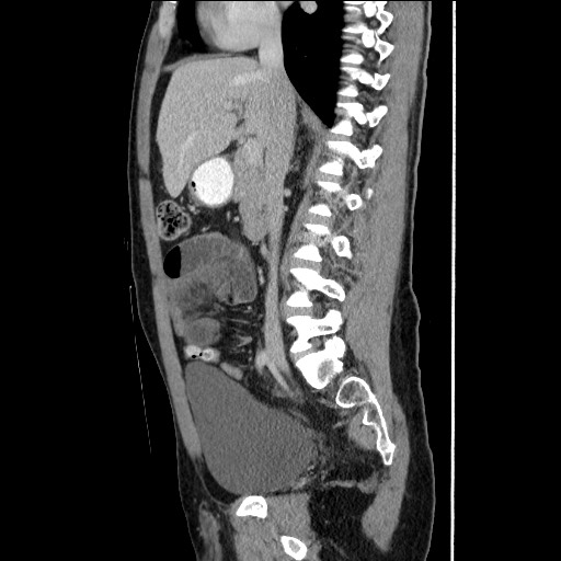 File:Closed-loop small bowel obstruction (Radiopaedia 73713-84509 B 75).jpg