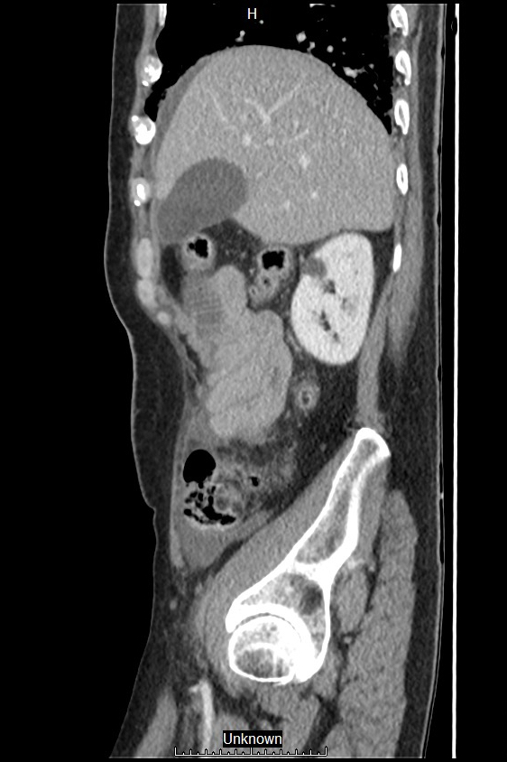 Closed loop bowel obstruction and ischemia (Radiopaedia 86959-103180 C 52).jpg