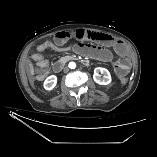 Closed loop obstruction due to adhesive band, resulting in small bowel ischemia and resection (Radiopaedia 83835-99023 B 69).jpg
