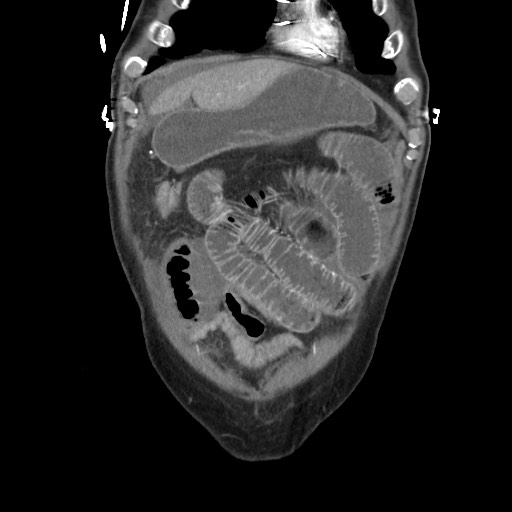 File:Closed loop obstruction due to adhesive band, resulting in small bowel ischemia and resection (Radiopaedia 83835-99023 C 29).jpg