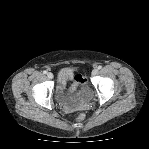 File:Closed loop small bowel obstruction (Radiopaedia 65403-74451 Axial 54).jpg