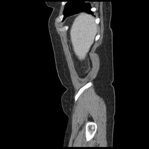 File:Closed loop small bowel obstruction (Radiopaedia 65403-74451 C 3).jpg