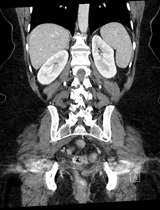 Closed loop small bowel obstruction - adhesions (Radiopaedia 59078-66369 B 88).jpg