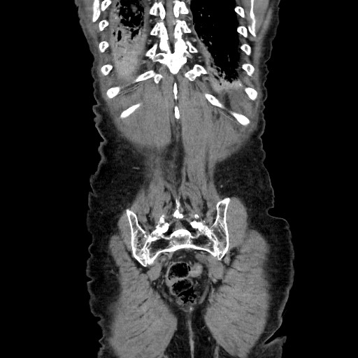 Closed loop small bowel obstruction - adhesive disease and hemorrhagic ischemia (Radiopaedia 86831-102990 B 112).jpg