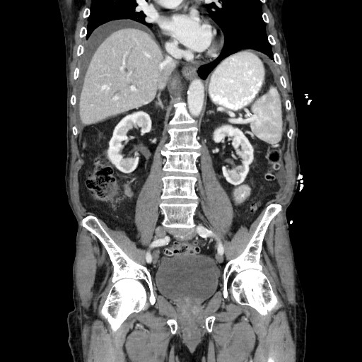 Closed loop small bowel obstruction - adhesive disease and hemorrhagic ischemia (Radiopaedia 86831-102990 B 76).jpg