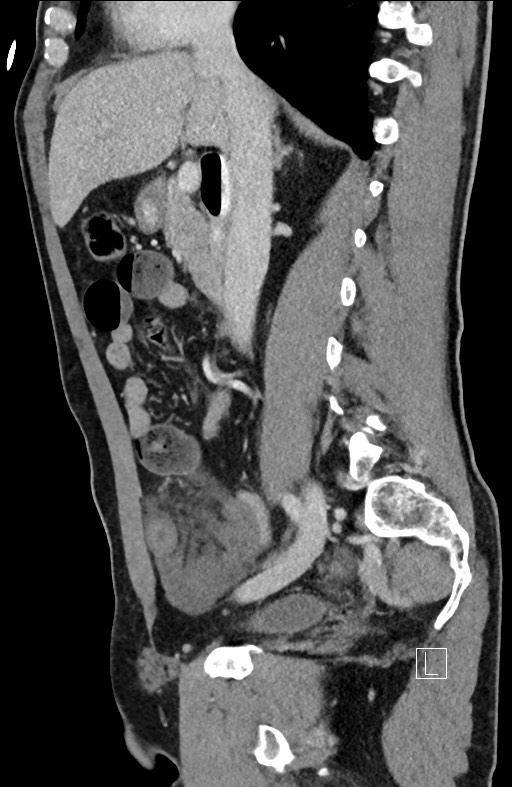 Closed loop small bowel obstruction - internal hernia (Radiopaedia 57806-64778 C 67).jpg