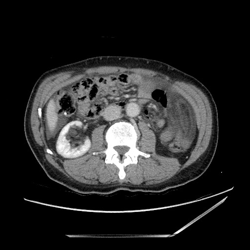 File:Closed loop small bowel obstruction - omental adhesion causing "internal hernia" (Radiopaedia 85129-100682 A 78).jpg