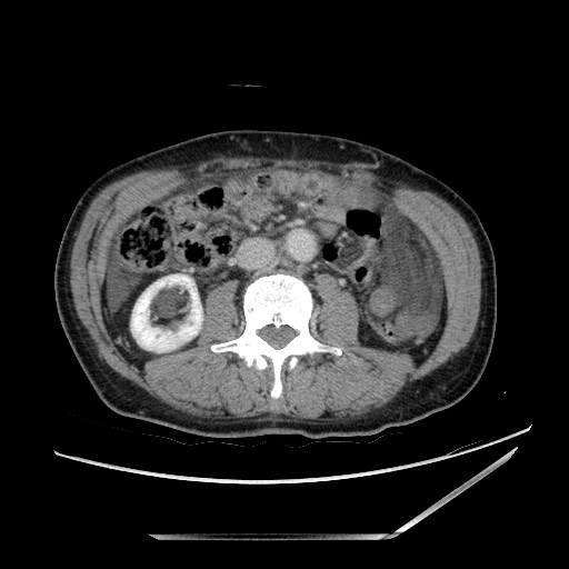 Closed loop small bowel obstruction - omental adhesion causing "internal hernia" (Radiopaedia 85129-100682 A 82).jpg