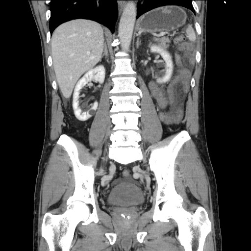 Closed loop small bowel obstruction - omental adhesion causing "internal hernia" (Radiopaedia 85129-100682 B 80).jpg