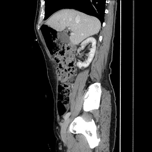 Closed loop small bowel obstruction - omental adhesion causing "internal hernia" (Radiopaedia 85129-100682 C 66).jpg